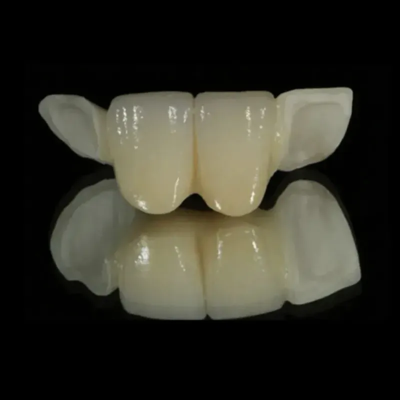 Posterior Zirconium Maryland Bridge